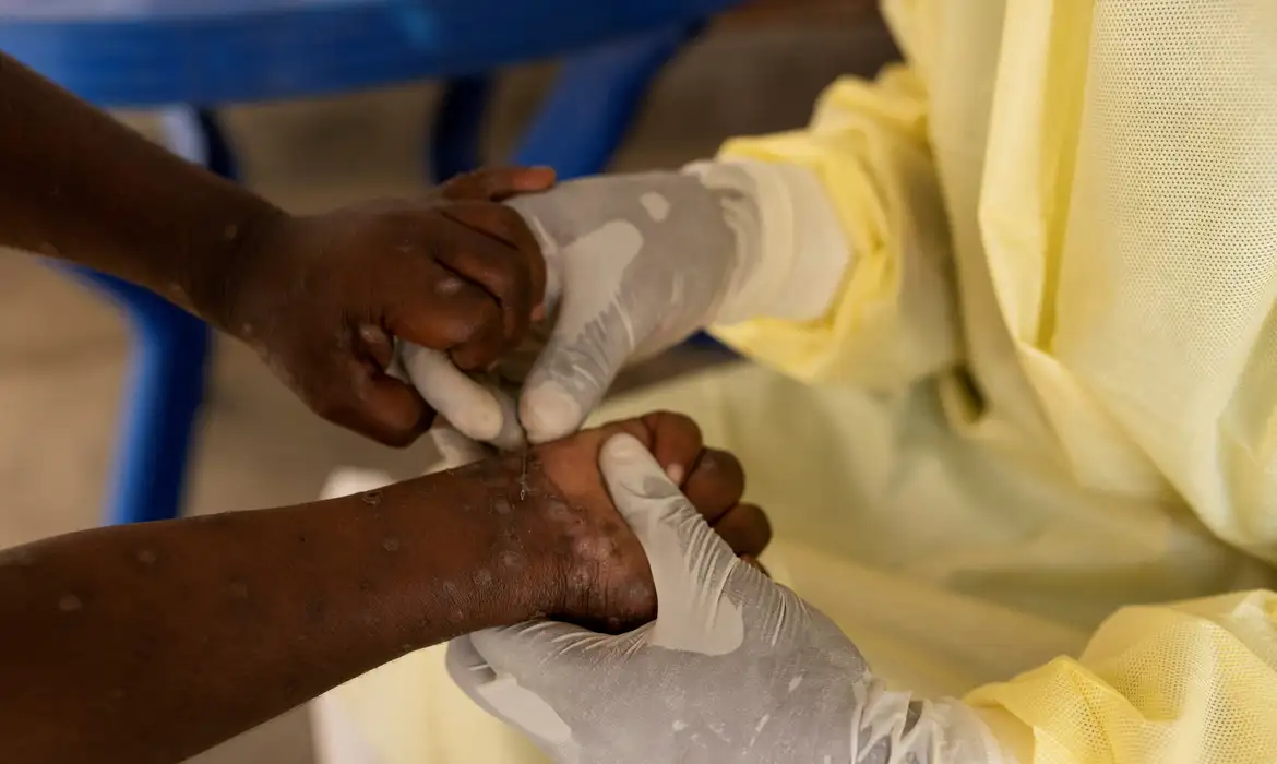 RDC espera receber primeiras vacinas contra mpox até próxima semana