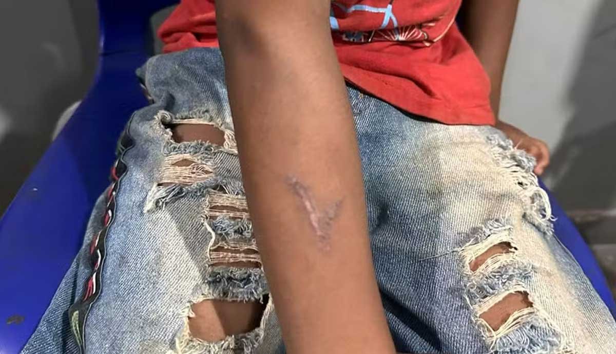 Pecuarista é acusado de ferir braço de menino indígena com ferro de marcar boi na Ilha do Bananal