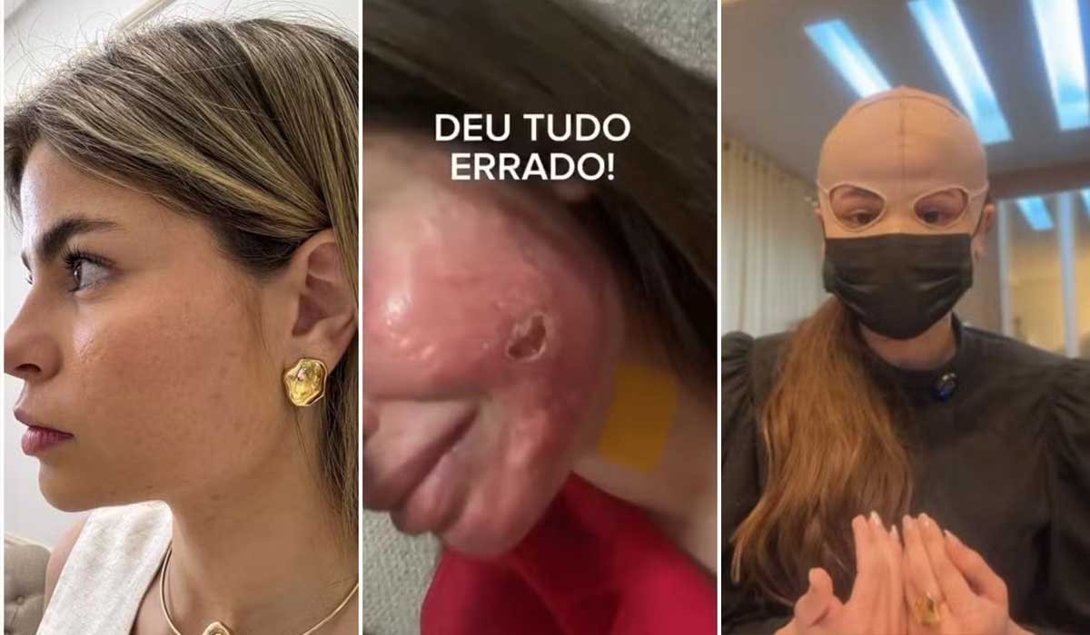 Médica terá que usar mascara por 6 meses ao sofrer queimaduras graves no rosto após peeling - Sou Mais Notícias